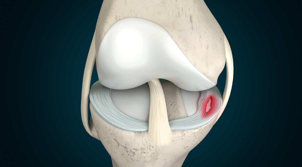 Rách sụn chêm đầu gối có nguy hiểm không? Dấu hiệu nhận biết [🆕🇻🇳] citigym.com.vn