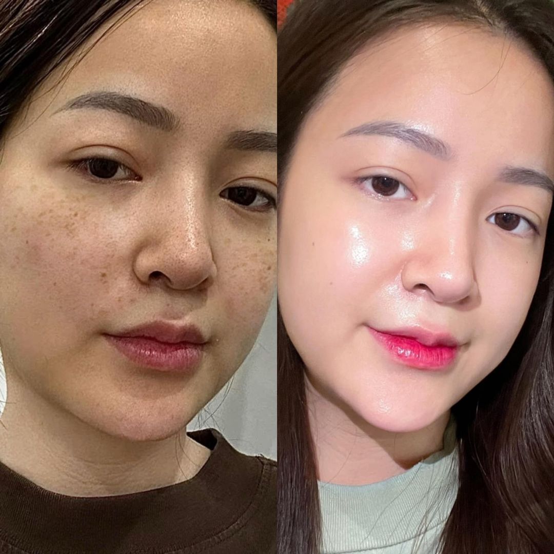 [🆕🇻🇳] Gạo Baby – Chuyên QC Cho Bé 🧑‍🧒❤️️👶⭐️ QUÁ TRỜI !!! Nói các bà ko tin, giờ chả mấy ai đi bắn la.s.e.r tri.nám đâu, vừa tốn kém vừa k hết, námm còn mọc đậm hơn nữa á ! Bà nào bất lực vì námm, tìm , shares-0✔️ , likes-35❤️️ , date-2024-06-22 01:09:37🇻🇳🇻🇳🇻🇳📰🆕